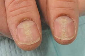What are the Causes of Brittle Nails - Growing Long Nails