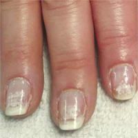 Damaged Nails Incorrect Removal