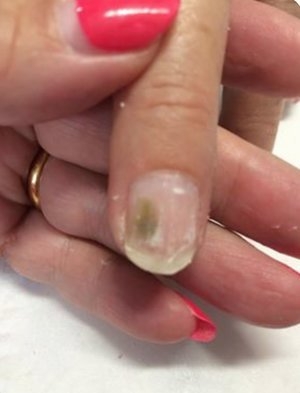 Is it nail mould? Katie Barnes explores... - Scratch Magazine