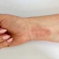 Eczema Copy