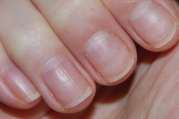 Ridged nails? Here's why - and how to treat them - Scratch Magazine