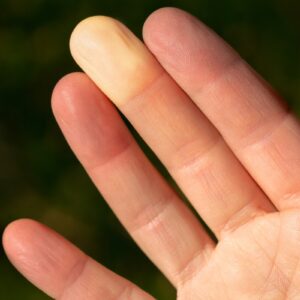 Raynaud's