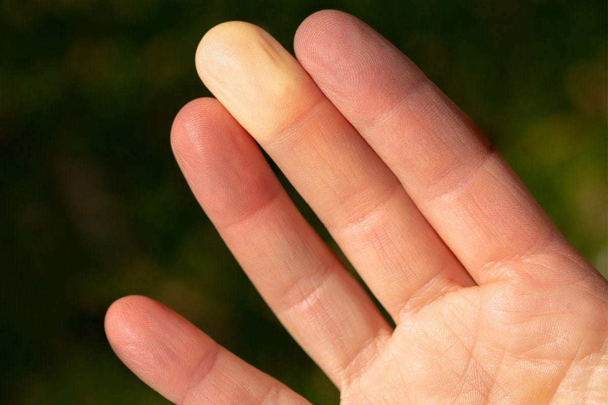 Raynaud's