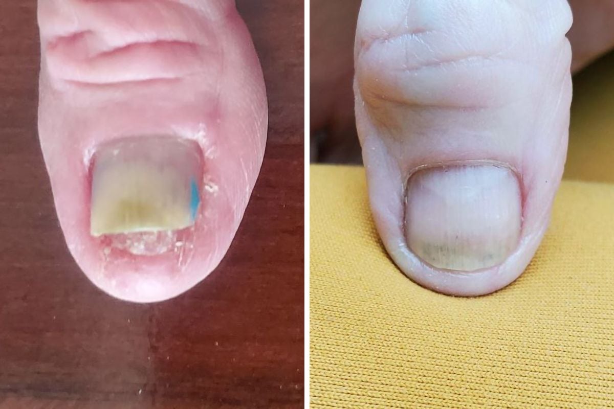 Suffering from nail separation? ACESO™ system delivers targeted results