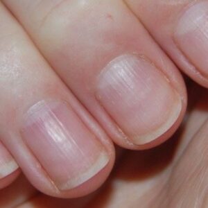 Nail Ridges