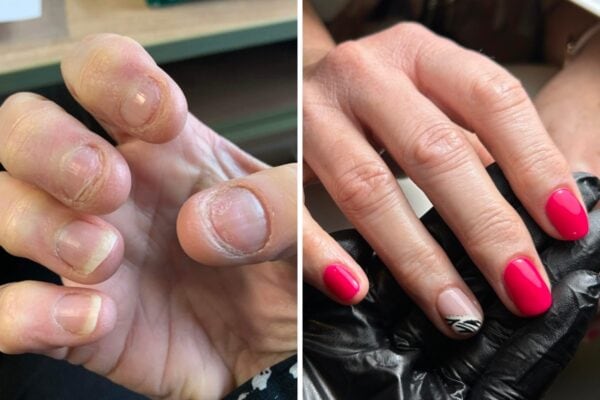 Hannah Clayton Nail Biting Client Before After