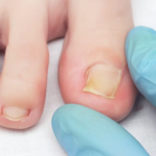 Ingrown Nail