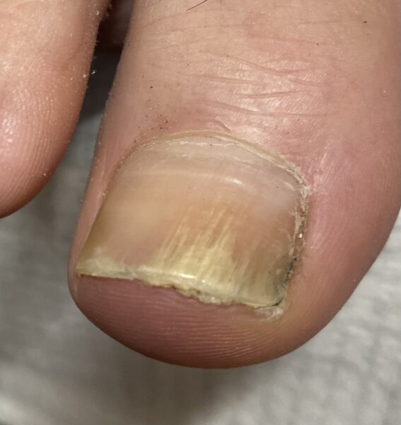 Tanya Onychomycosis