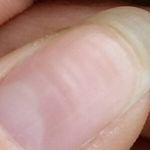 Beau's lines