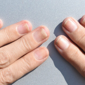Onycholysis image