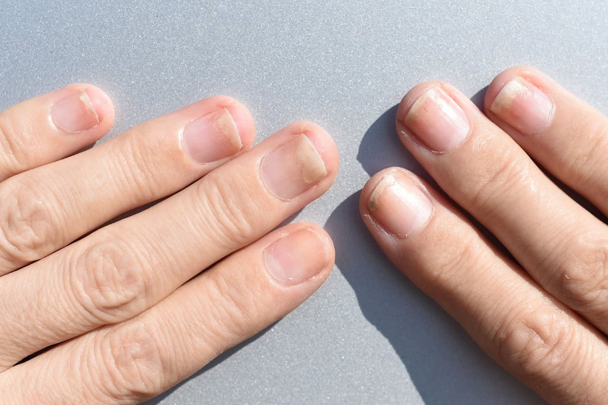 Onycholysis image Onycholysis image