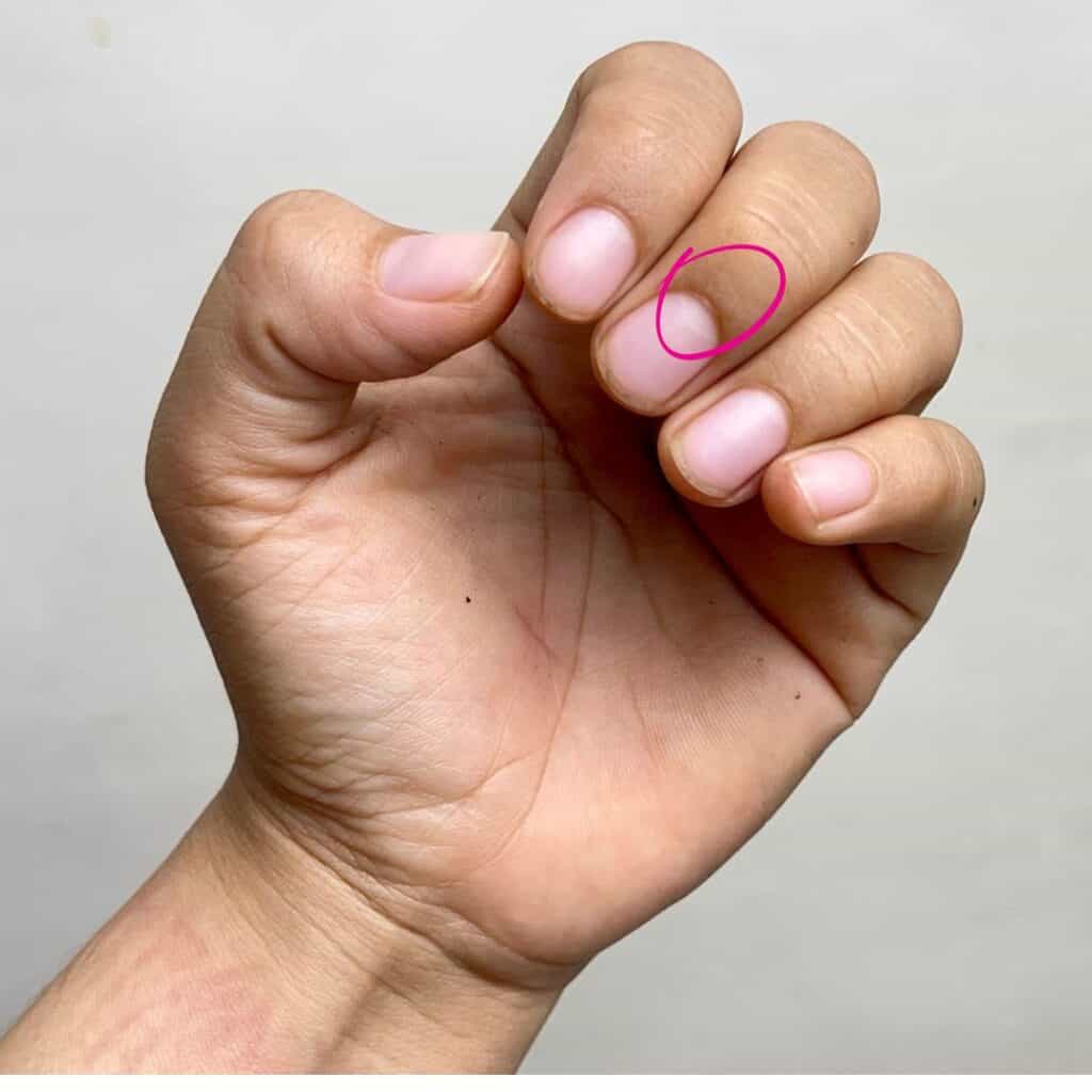 The nail matrix position